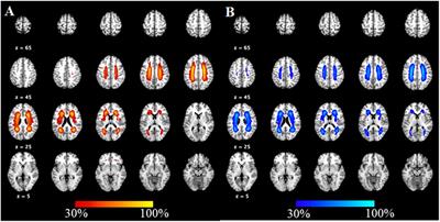Cortical Thinning in the Medial Temporal Lobe and Precuneus Is Related to Cognitive Deficits in Patients With Subcortical Ischemic Vascular Disease